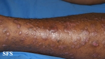 epidermolysis bullosa pruriginosa