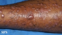 epidermolysis bullosa pruriginosa