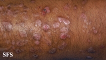 epidermolysis bullosa pruriginosa