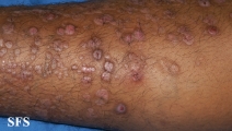 epidermolysis bullosa pruriginosa