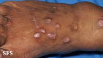 epidermolysis bullosa pruriginosa