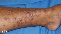 epidermolysis bullosa pruriginosa