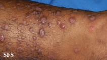 epidermolysis bullosa pruriginosa