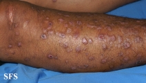epidermolysis bullosa pruriginosa