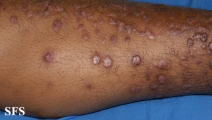 epidermolysis bullosa pruriginosa