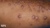 epidermolysis bullosa pruriginosa