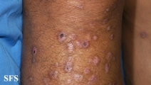 epidermolysis bullosa pruriginosa