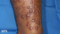 epidermolysis bullosa pruriginosa