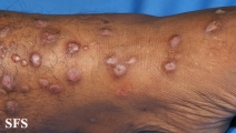 epidermolysis bullosa pruriginosa