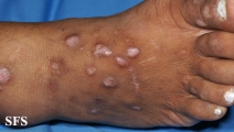 epidermolysis bullosa pruriginosa