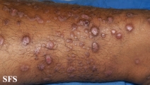 epidermolysis bullosa pruriginosa