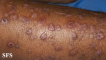 epidermolysis bullosa pruriginosa