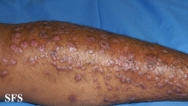 epidermolysis bullosa pruriginosa