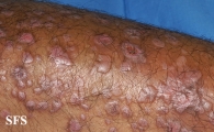 epidermolysis bullosa pruriginosa
