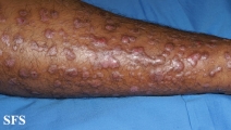 epidermolysis bullosa pruriginosa