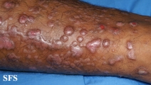epidermolysis bullosa pruriginosa