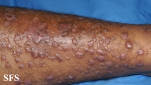 epidermolysis bullosa pruriginosa