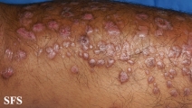 epidermolysis bullosa pruriginosa