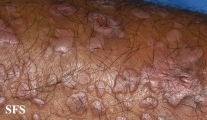epidermolysis bullosa pruriginosa