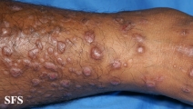 epidermolysis bullosa pruriginosa