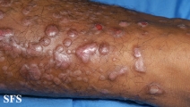 epidermolysis bullosa pruriginosa