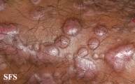 epidermolysis bullosa pruriginosa