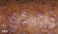 epidermolysis bullosa pruriginosa