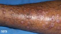 epidermolysis bullosa pruriginosa