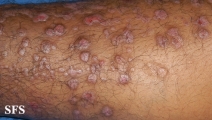 epidermolysis bullosa pruriginosa