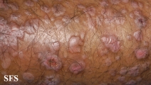 epidermolysis bullosa pruriginosa
