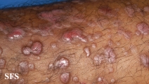 epidermolysis bullosa pruriginosa