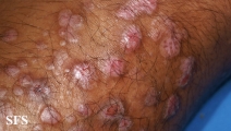 epidermolysis bullosa pruriginosa