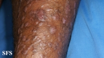 epidermolysis bullosa pruriginosa