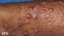 epidermolysis bullosa pruriginosa