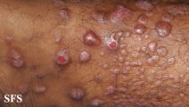 epidermolysis bullosa pruriginosa