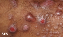 epidermolysis bullosa pruriginosa