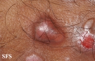 epidermolysis bullosa pruriginosa