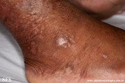 epidermolysis bullosa pruriginosa