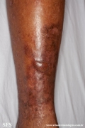 epidermolysis bullosa pruriginosa