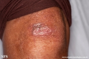 epidermolysis bullosa pruriginosa