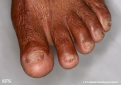 epidermolysis bullosa pruriginosa