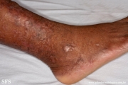 epidermolysis bullosa pruriginosa