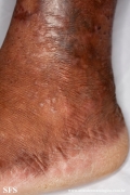 epidermolysis bullosa pruriginosa