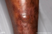 epidermolysis bullosa pruriginosa