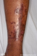 epidermolysis bullosa pruriginosa
