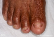 epidermolysis bullosa pruriginosa