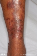 epidermolysis bullosa pruriginosa