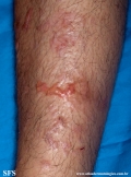 epidermolysis bullosa pruriginosa