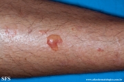 epidermolysis bullosa pruriginosa