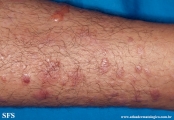 epidermolysis bullosa pruriginosa